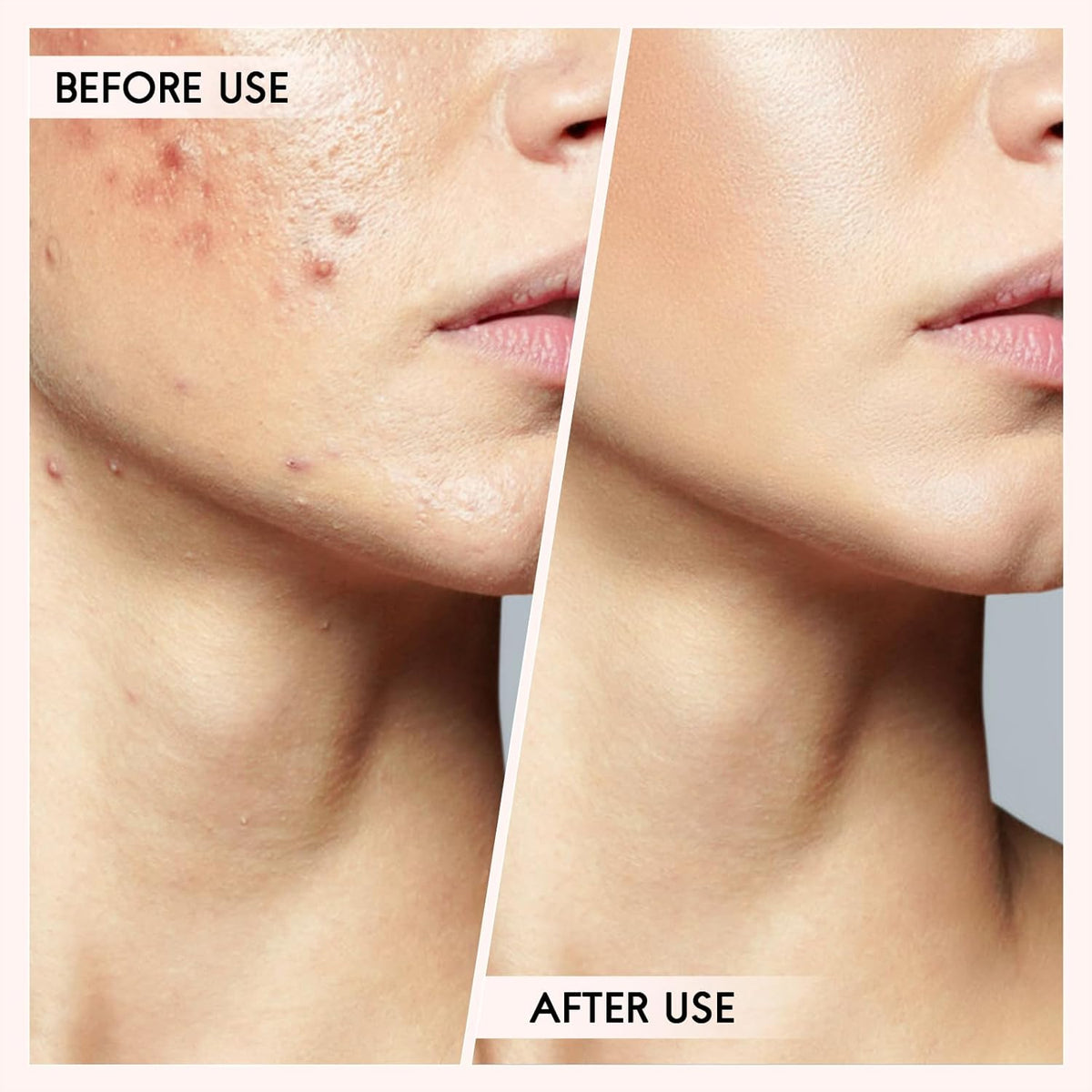 Home Skin Care Tool Set for Safe Extraction of Blackheads and Pimples