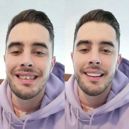 Instant Confidence Tooth Covers for Upper and Lower Teeth – Realistic Smile