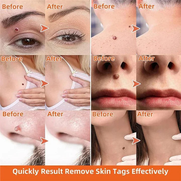 Precision Tool for Safe Skin Tag Removal at Home