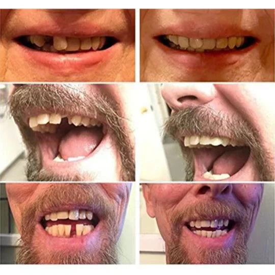 Instant Smile Enhancers - Temporary Dental Veneers