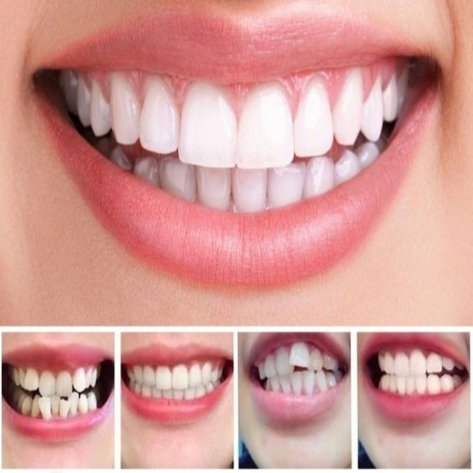 Progressive Dental Alignment Trays for Perfect Smile