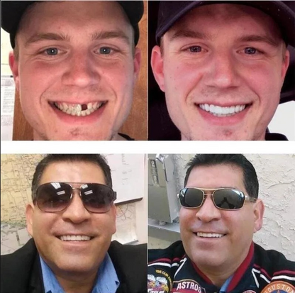 Easy-Fit Denture Covers for Natural Smiles