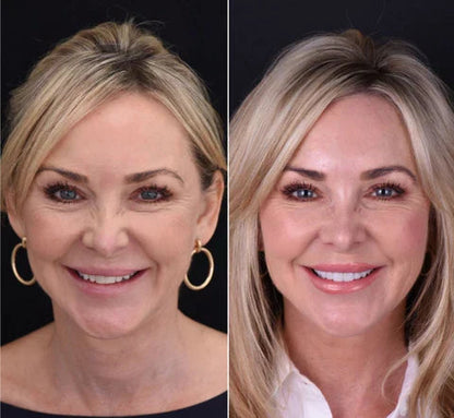 Custom Fit Removable Veneers Set for Upper and Lower Teeth - Natural Smile