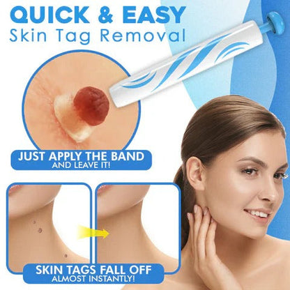 Precision Tool for Safe Skin Tag Removal at Home