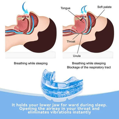 Customizable Anti-Snore Mouthpiece for Comfortable Sleep Support