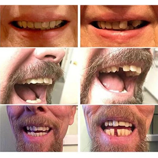 Instant Smile Enhancer for Temporary Cosmetic Use