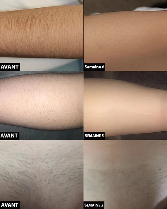 Personal Laser Hair Reduction System for Home Use