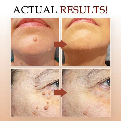 Natural Skin Growth Eliminator with Tea Tree Essence