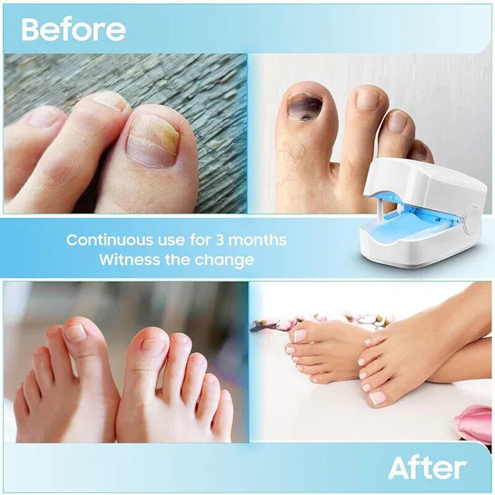 Home Laser Treatment for Nail Fungus with Rechargeable Battery