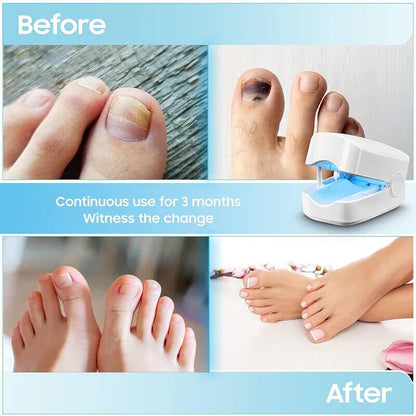 Home Laser Treatment for Nail Fungus with Rechargeable Battery